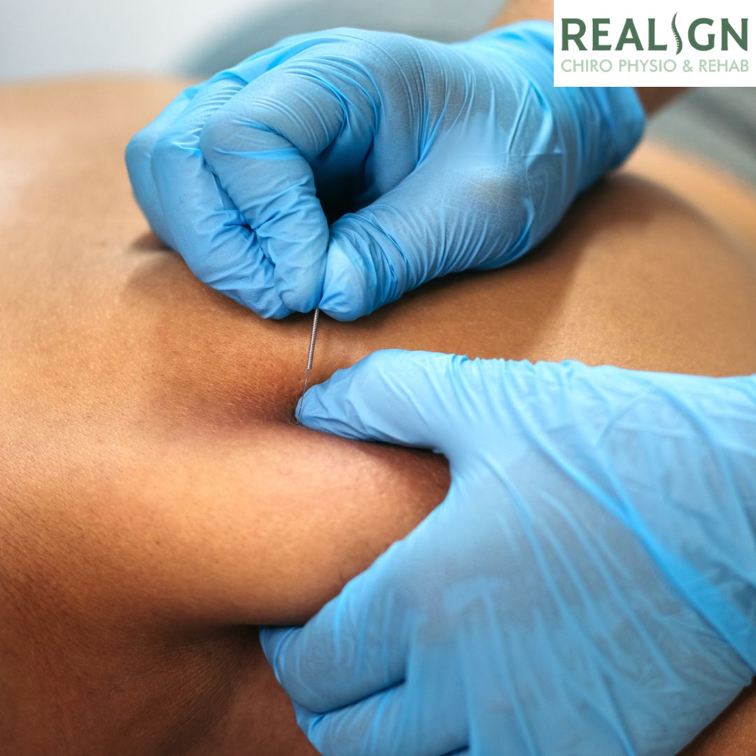 dry needling physiotherapy in langley