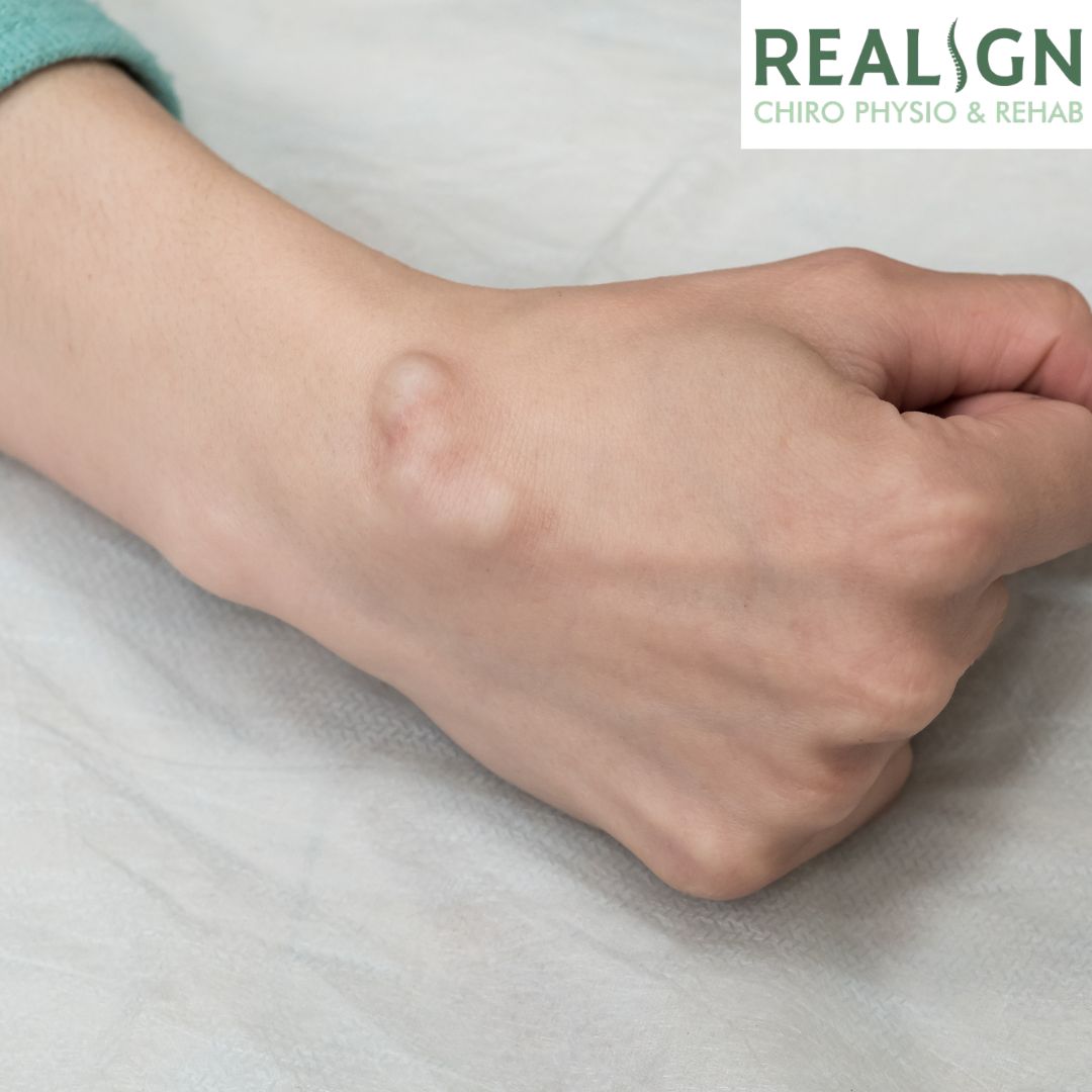 ganglion cyst